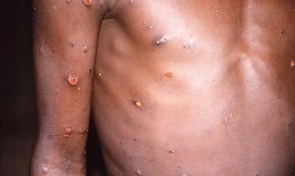  Bahia confirma primeiros casos de Mpox em 2026 e acende alerta para vigilância sanitária